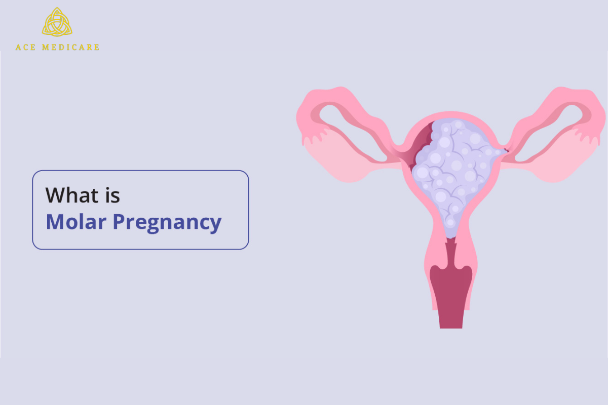 Understanding Molar Pregnancy: Causes, Symptoms, and Treatment